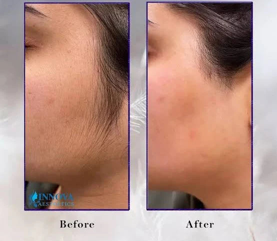 Wiki Hair Blocker Cream – Unwanted Hair Reduction Cream for Face & Body