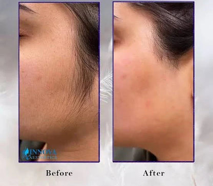 Wiki Hair Blocker Cream – Unwanted Hair Reduction Cream for Face & Body